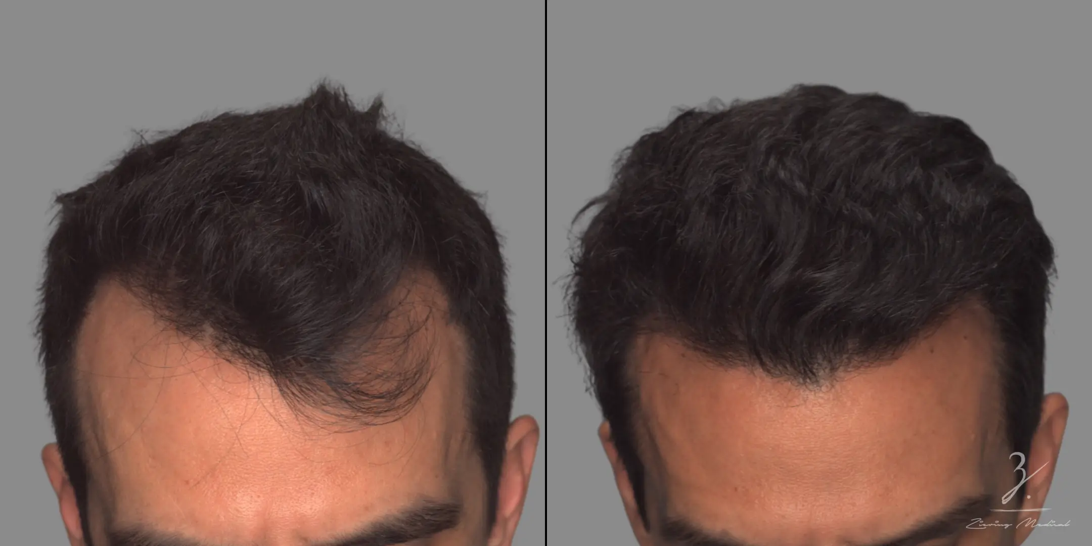 Men’s Hair Replacement That Matches Your Style